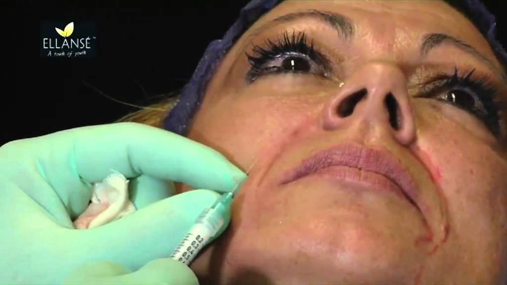 Watch Now Correzione Linee della Marionetta con Ellansé Correzione Linee della Marionetta con Ellansé