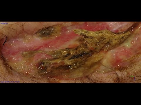 Ginocchio anterior grado instabilità 3 Dolore nella parte del collo