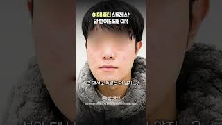 여드름 흉터는 큐어젯 시술로 해결!