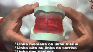 Curso de prótese total com Enilson Carneiro - Parte 2.
