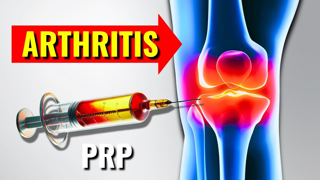Do PRP Injections Work for Severe Knee Arthritis? What the Research Shows