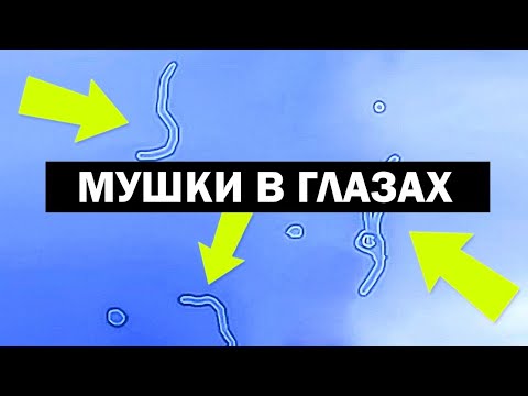 Плавающие мушки перед глазами. Глазные мушки. Нити и мушки в глазах. Шум в ушах мушки перед глазами. Шум перед глазами.
