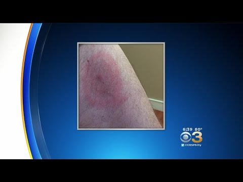 Lyme Disease Cases At An All Time High In NJ, Pa.