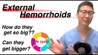 Life cycle of External Hemorrhoids! From baby to adult. | Dr. Chung explains!