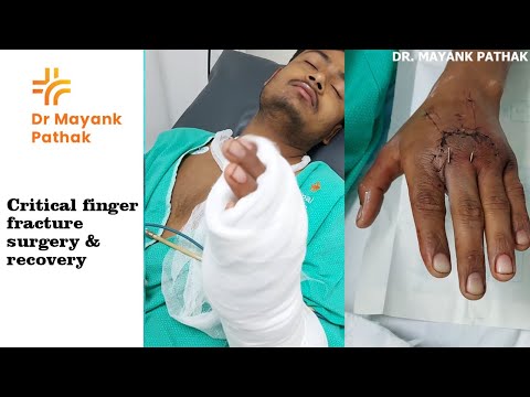 From Critical finger fracture surgery to complete recovery| Dr. Mayank Pathak