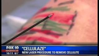 preview picture of video 'Removing Cellulite with Cellulaze -  New Laser Procedure - Paradise Valley, Arizona'