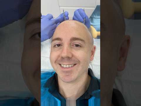 Singer/Singwriter John Galea visited the British Hair Clinic in Essex to have his hairline restored