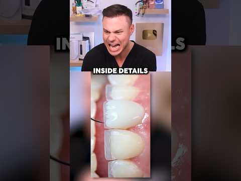 Dentist Reveals What REAL Professional Veneers Look Like! 😁🦷