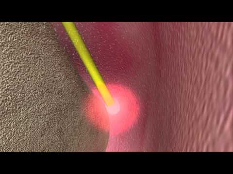 Laser Periodontal Therapy - WPT™ Animation