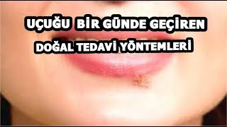 UÇUK NASIL GEÇER? UÇUĞU BİR GÜNDE GEÇİREBİLEN DOĞAL TEDAVİ YÖNTEMLERİ