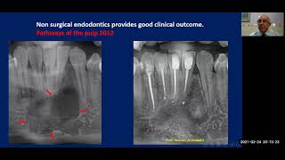 Periapical Lateral lesion healing