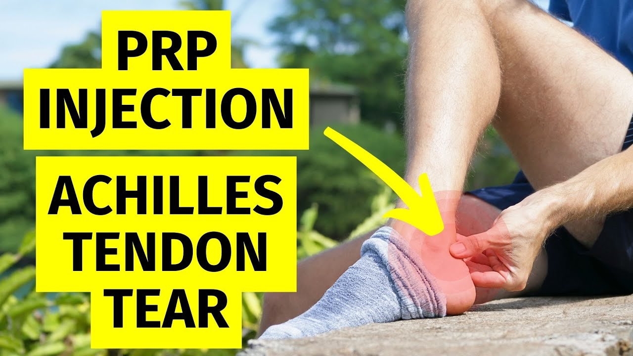 Platelet Rich Plasma (PRP) Injection for Achilles Tendon Tear