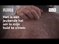 Jimmy heeft een huidaandoening verspreid over zijn hele lichaam.