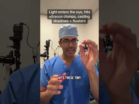 Eye floaters after cataract surgery