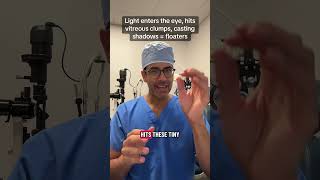 Eye floaters after cataract surgery