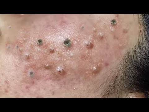 Relaxing everyday with Us – Blackhead
