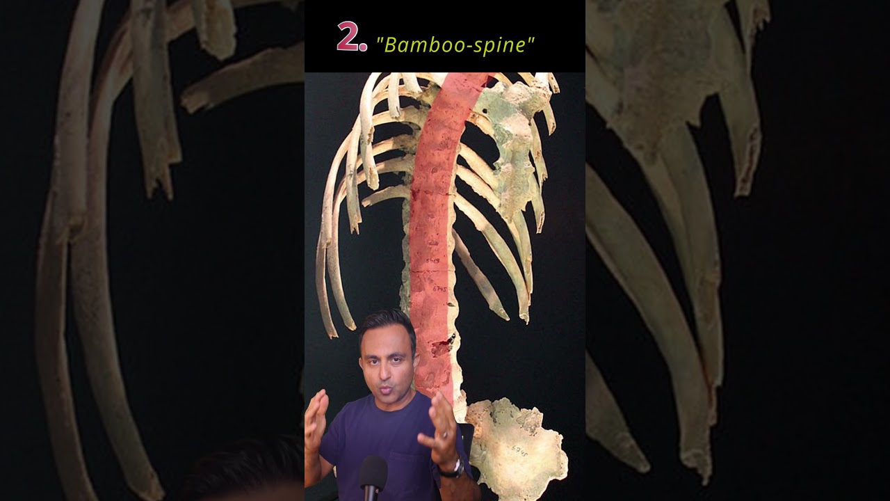 #ankylosingspondylitis