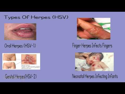 The Largest Confidential Herpes & STD