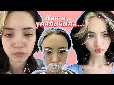 Как я увеличила губы (нервно)