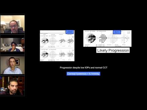 Stratyfikacja ryzyka progresji jaskry na podstawie histerezy rogówki