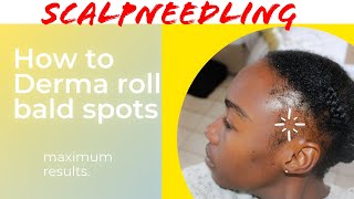 How to Derma roll BALD spots & edges for MAXIMUM  HAIR growth! Natural Hairline regrowth