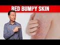 #1 Perfect Remedy for Keratosis Pilaris (CHICKEN SKIN)