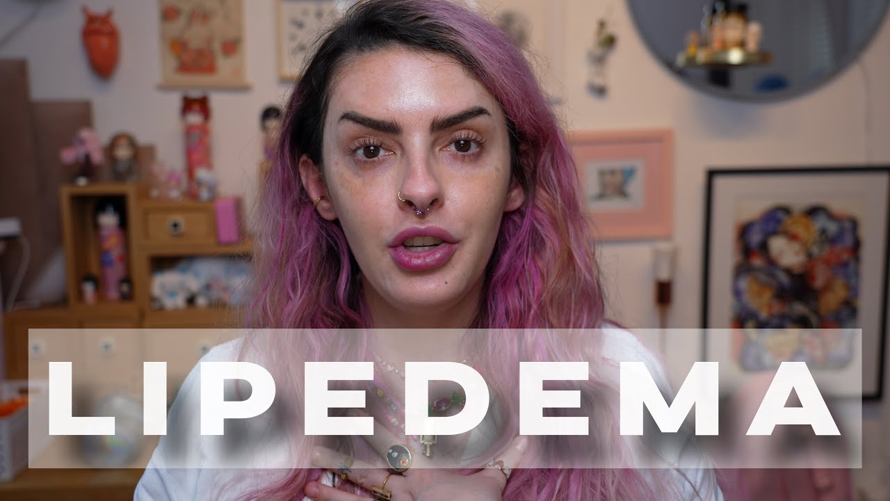 TUDO SOBRE LIPEDEMA E O MEU DIAGNÓSTICO - Karen Bachini