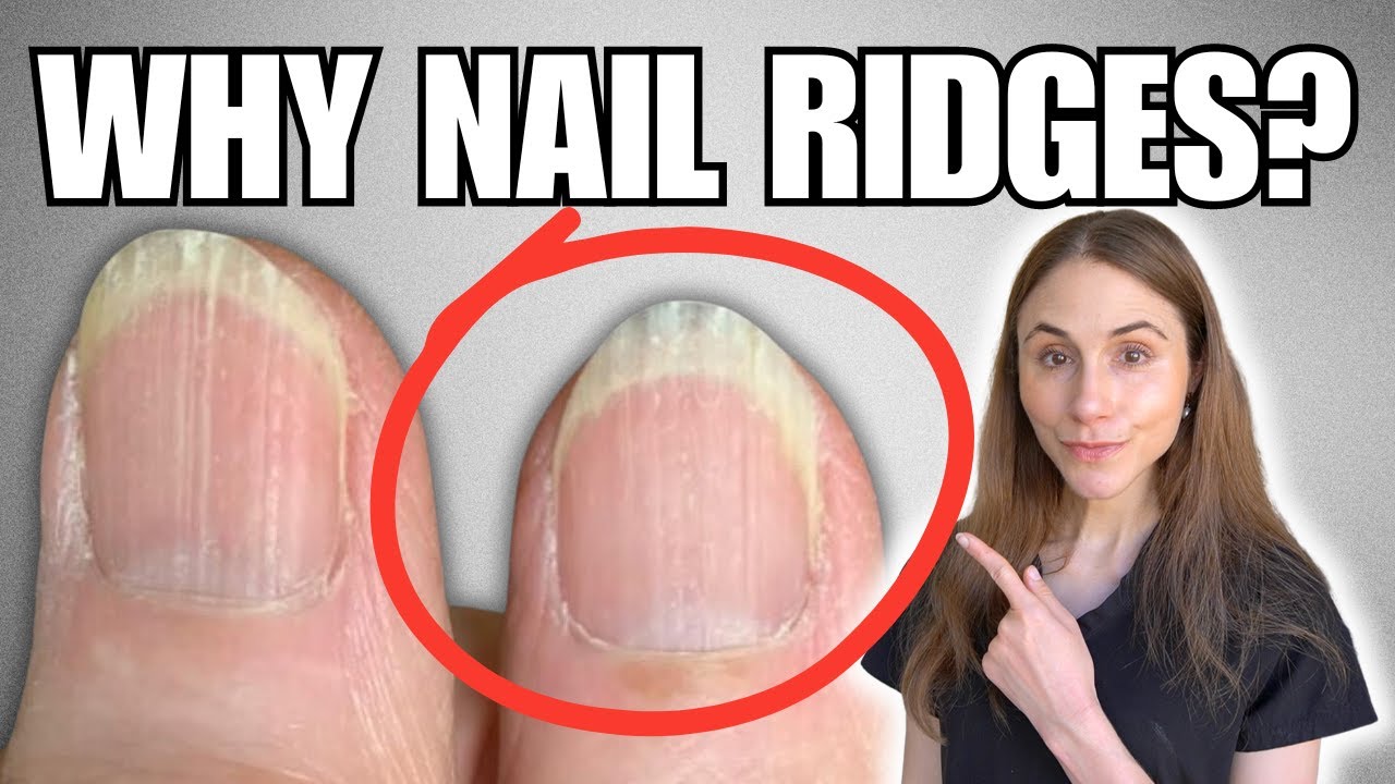Why You Have Vertical Nail Ridges And How To Get Rid Of Them