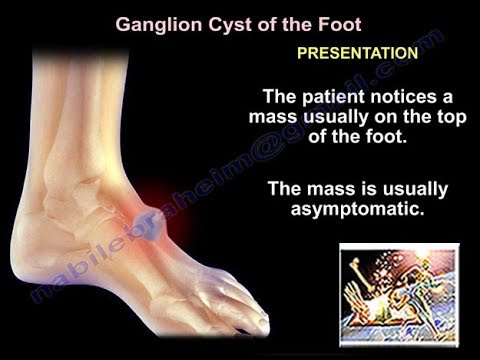 Foot and  Ankle ganglion cyst   - Everything You Need To Know - Dr. Nabil Ebraheim
