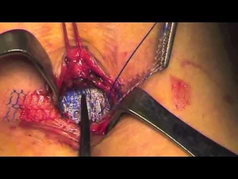 UCMC Clear Mesh Composite . Umbilical Hernia repair