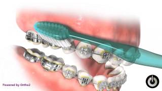 How to Maintain Proper Oral Hygiene During Treatment with Braces - Markham, ON