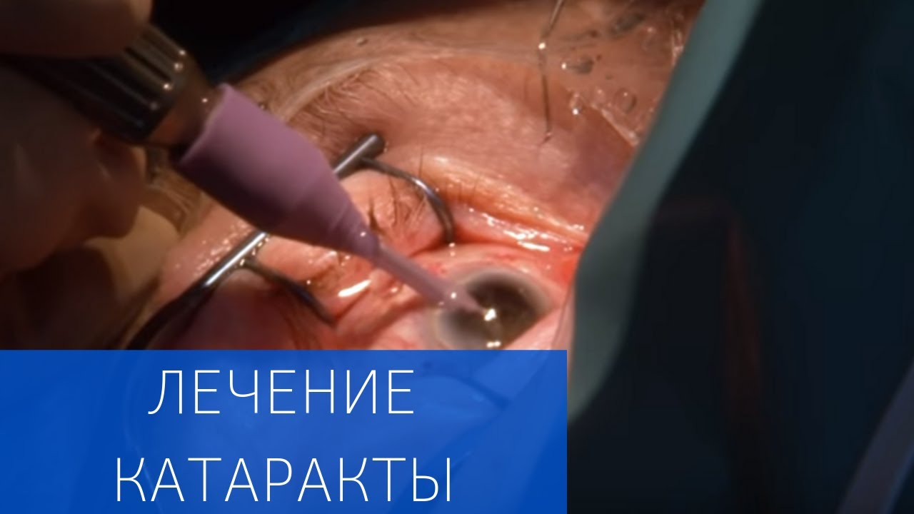 Хирургическое лечение катаракты в ЕМС