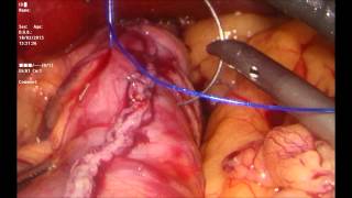 Gastrectomía Vertical Laparoscópica - Procedimiento completo