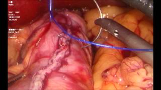 Gastrectomía Vertical Laparoscópica - Procedimiento completo - Manuel Prados Guzmán