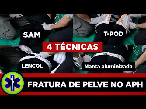 4 técnicas para estabilização de fratura de quadril (incluindo manta aluminizada)