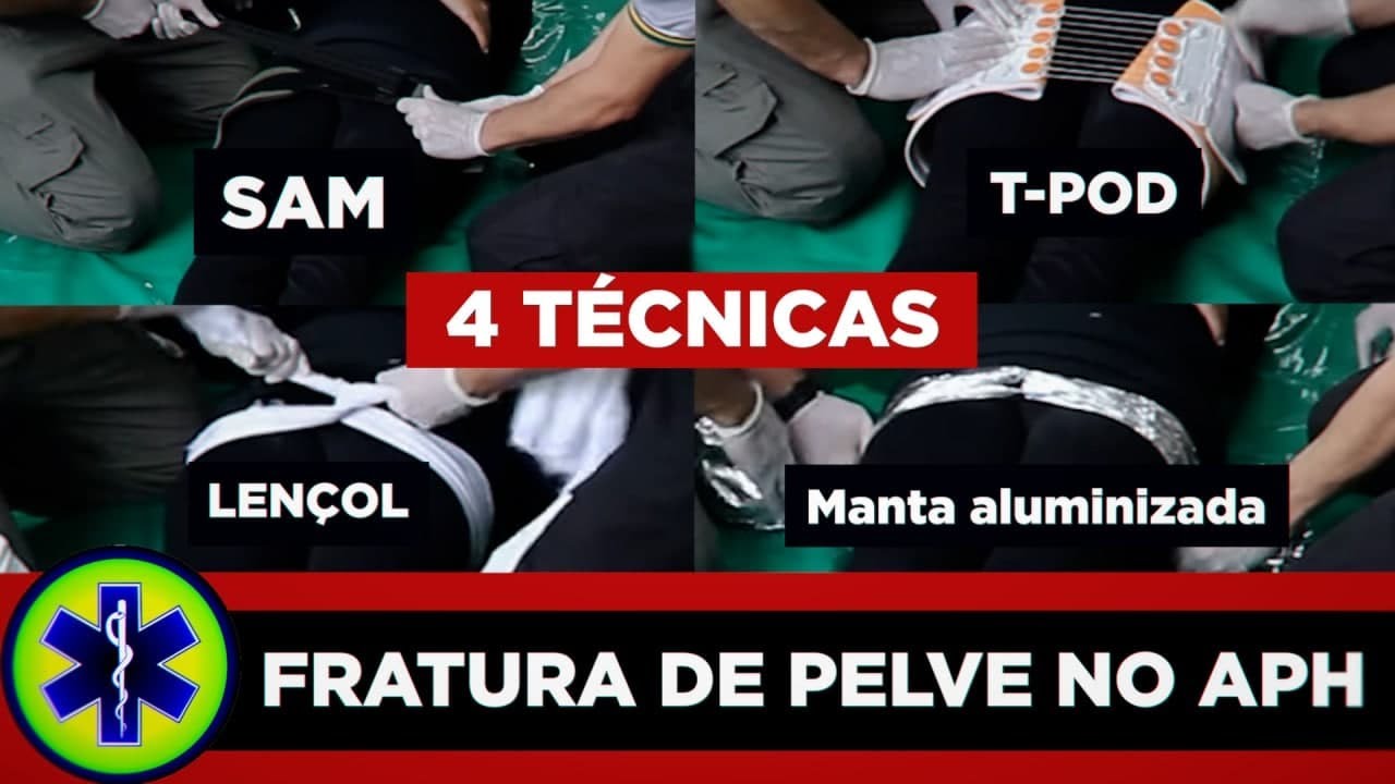 4 técnicas para estabilização de fratura de quadril (incluindo manta aluminizada)