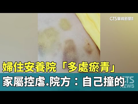 婦住安養院「多處瘀青」　家屬控虐　院方：自己撞的