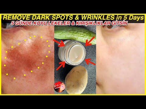 , title : 'With Potato - Cucumber Face Cream, I Removed DARK CIRCLES - WRINKLES in 5 Days! Skin Whitening'
