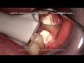 IMMEDIATE CERAMIC IMPLANT - MULTI ROOTED MOLAR - NON SURGICAL