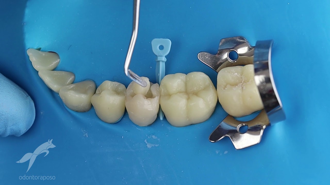 Restauração do dente 35 com princípios da Biomimética
