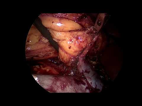 Laparoscopic right radical nephrectomy-hilum after dissection