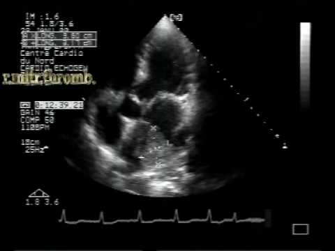 Mitral Stenosis In Different Aspects: Mitral Stenosis With Left Atrial Thrombus