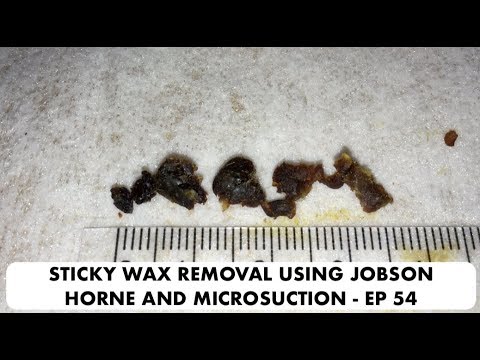 STICKY EAR WAX REMOVAL USING JOBSON HORNE AND MICROSUCTION - EP 54