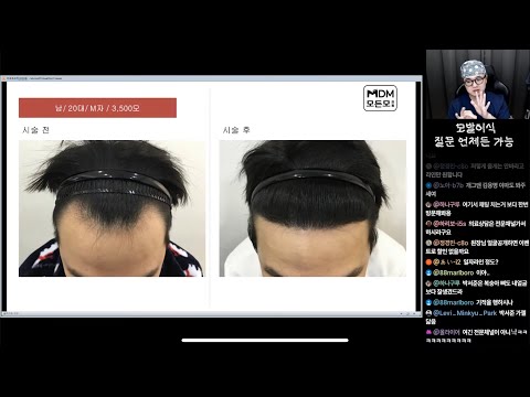 탈모 회생방안 + 채팅 차단 없는 퍼지데이 난장판