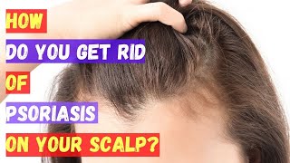 SCALP PSORIASIS | How do you get rid of psoriasis on your scalp?
