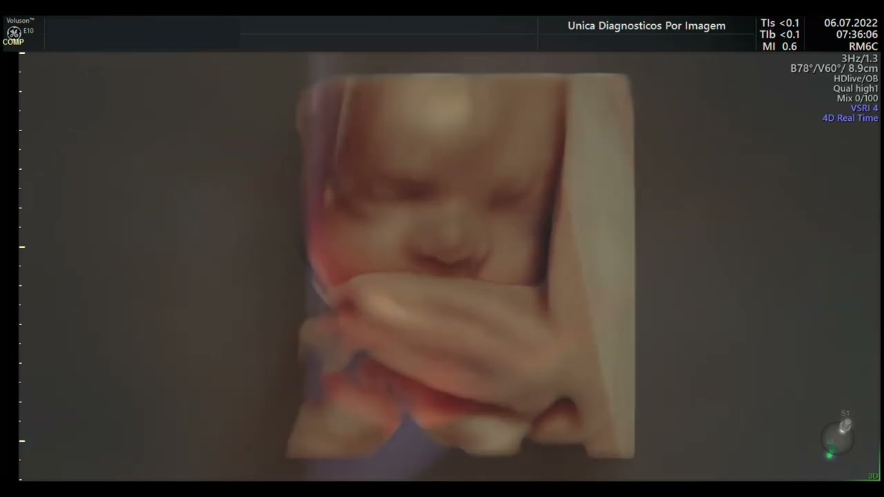 Ultrassom 4D HD Live - 06