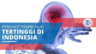 Stroke, Terjadi Ketika Pasokan Darah ke Otak Terganggu atau Terhenti sehingga Kekurangan Oksigen