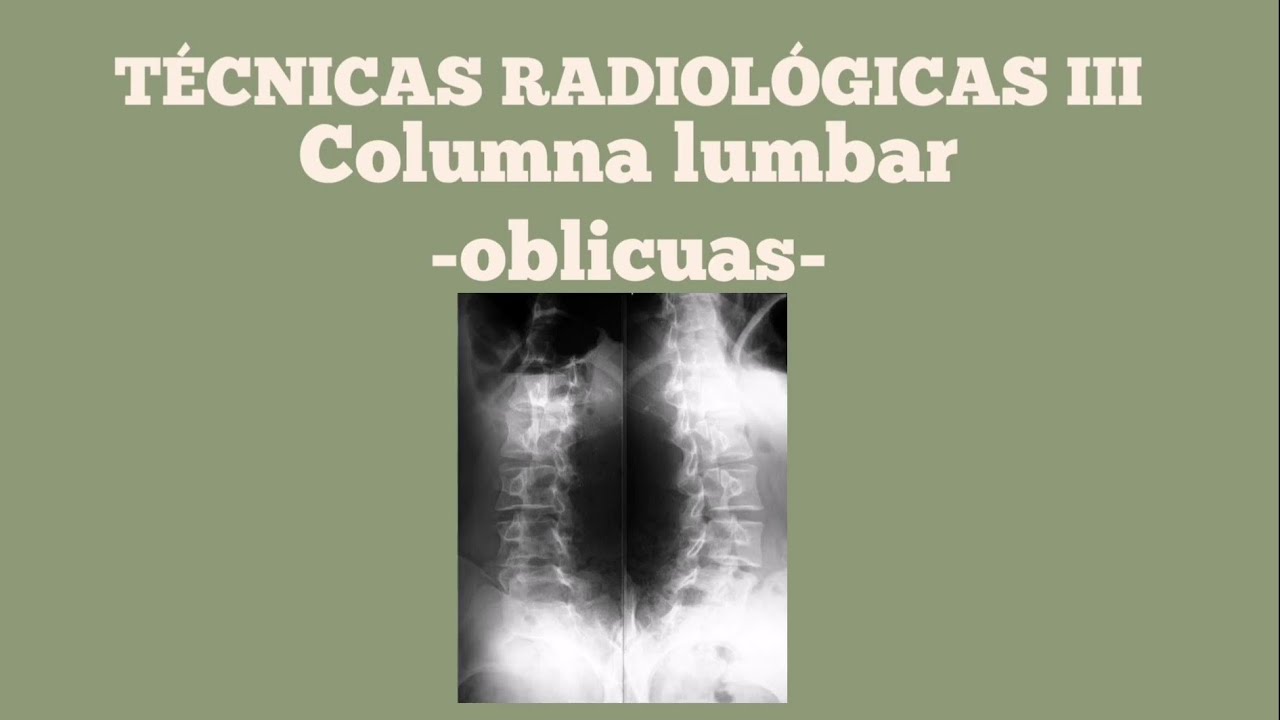 Proyección oblicua de columna lumbar