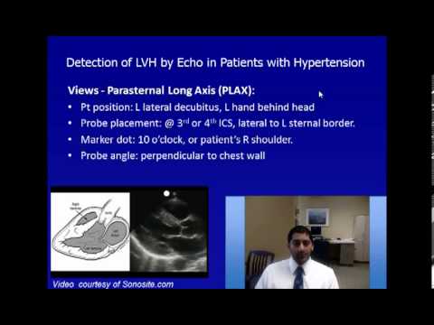 Detection of Left Ventricular Hypertrophy by Echocardiography