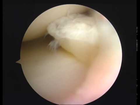 Come ottenere depositi di sale sulle giunzioni Diagnosi ecografica del ginocchio